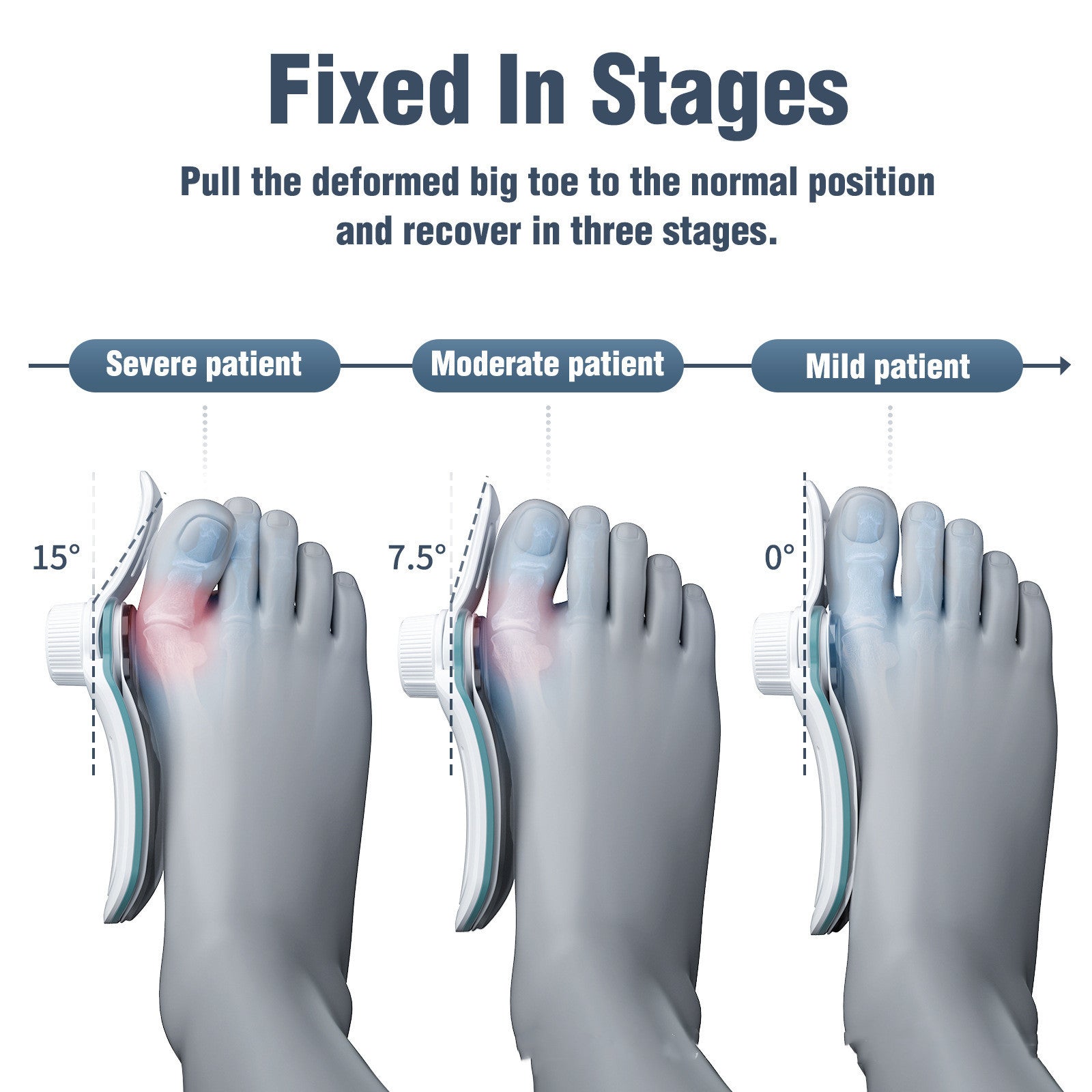 Nouvelle correction à 3 panneaux pour hommes et femmes de degrés variés de l’orthothèse du valgus du pouce